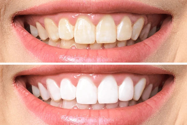 Hismile V34 ColorBoost Tooth Whitening System - Hi Smile